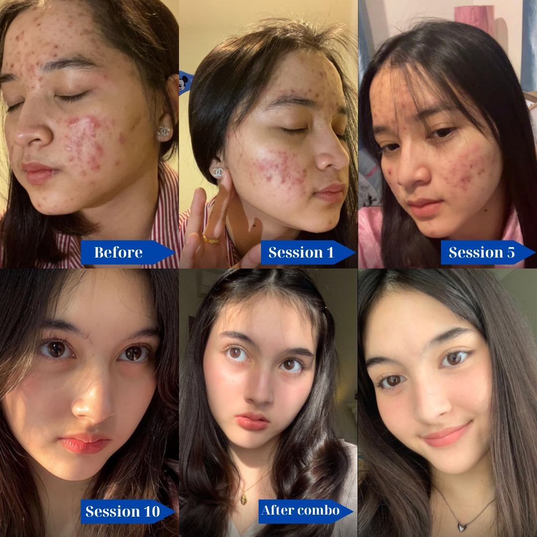 Handbag Facebook ad: HOW LONG DOES IT TAKE FOR ACNE CLEAN…