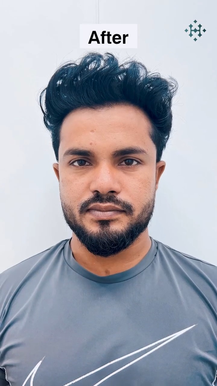 Dr. Haror's Wellness Facebook ad: Amit underwent a painless hair transplant last year…