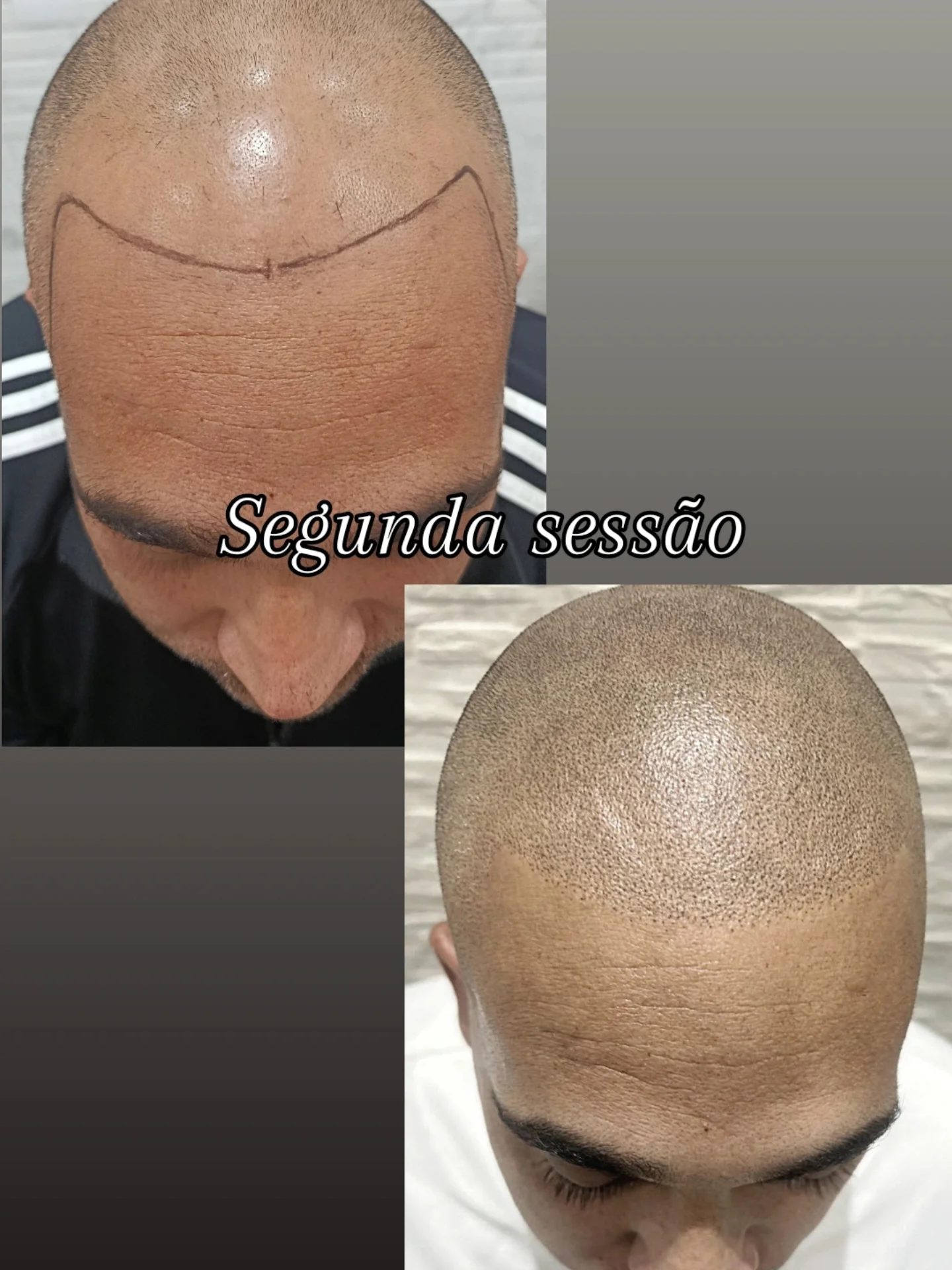 si_microcapilar Facebook ad: Segunda sessão de micropigmentação capilar