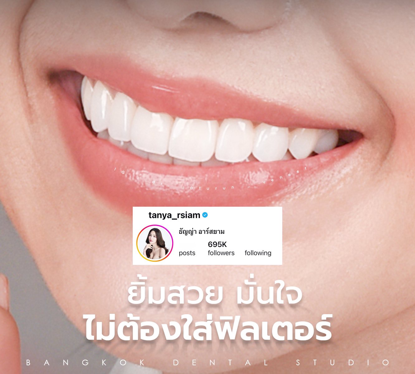 Bangkok Dental Studio-BDS บางกอก เด็นทัล สตูดิโอ ทำฟัน วีเนียร์ รากเทียม Facebook ad: หลังทำไม่ต้องแต่งรูปให้ฟันขาวอีกต่อไป ยิ้มได้อย่างมั่นใจ…
