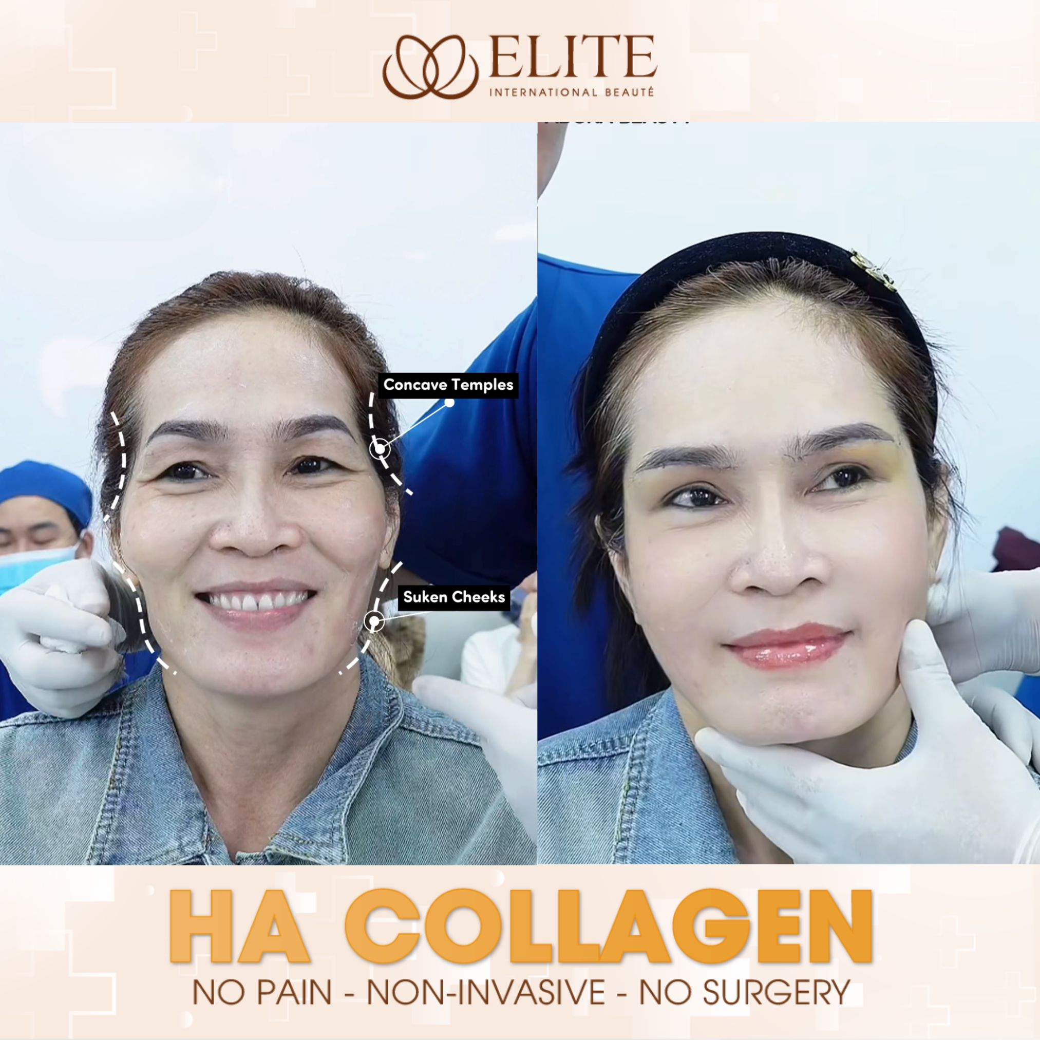 ELITE International Aesthetic Institute - Laguna Branch Facebook ad