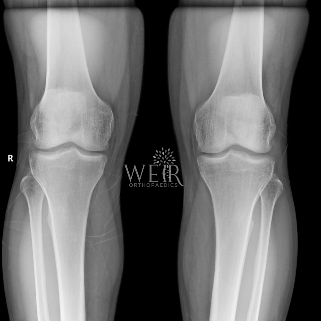 Weir Orthopaedics Facebook ad from Jun 2, 2026