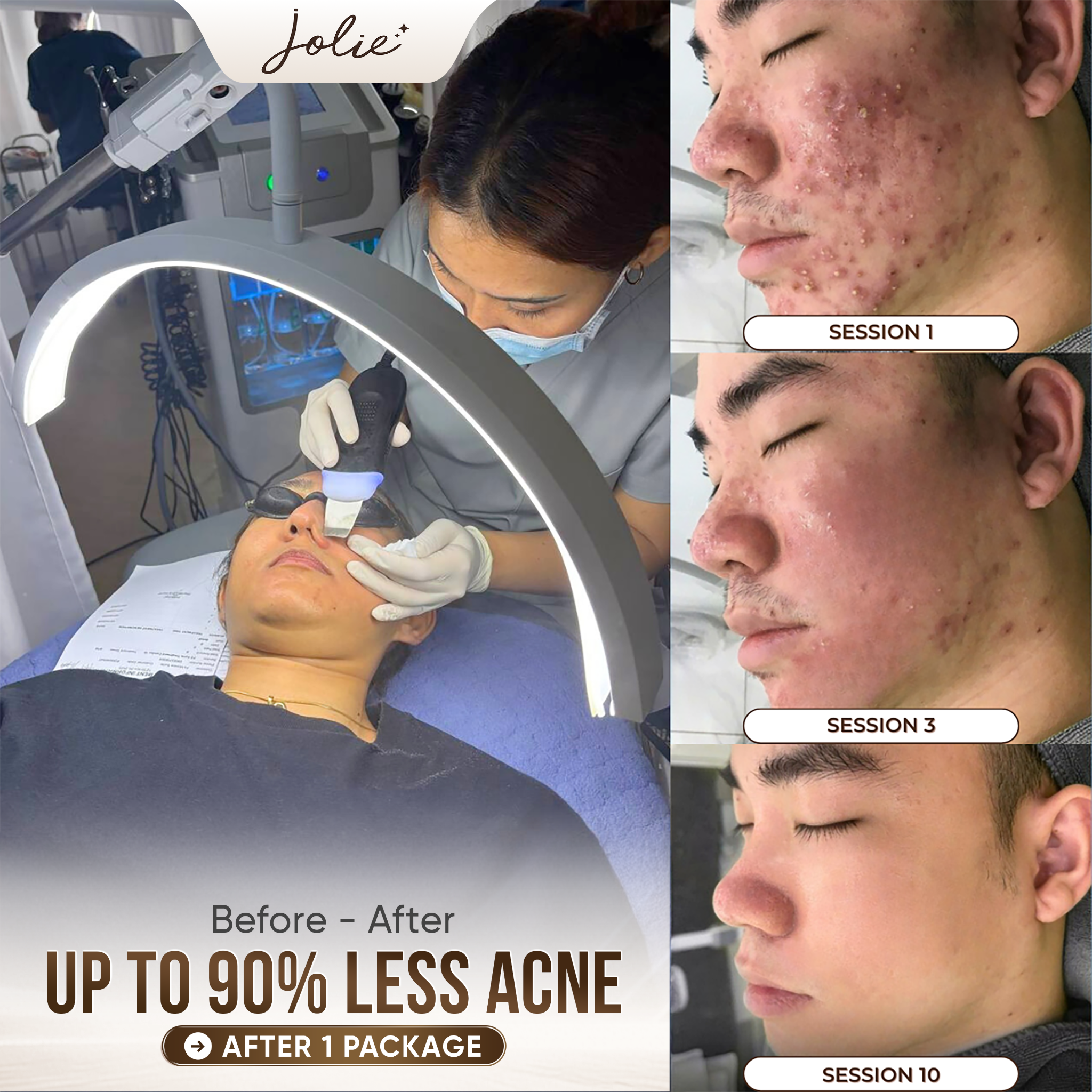 Jolie Beauty Clinic Facebook ad: Up to 90% improvement - book now