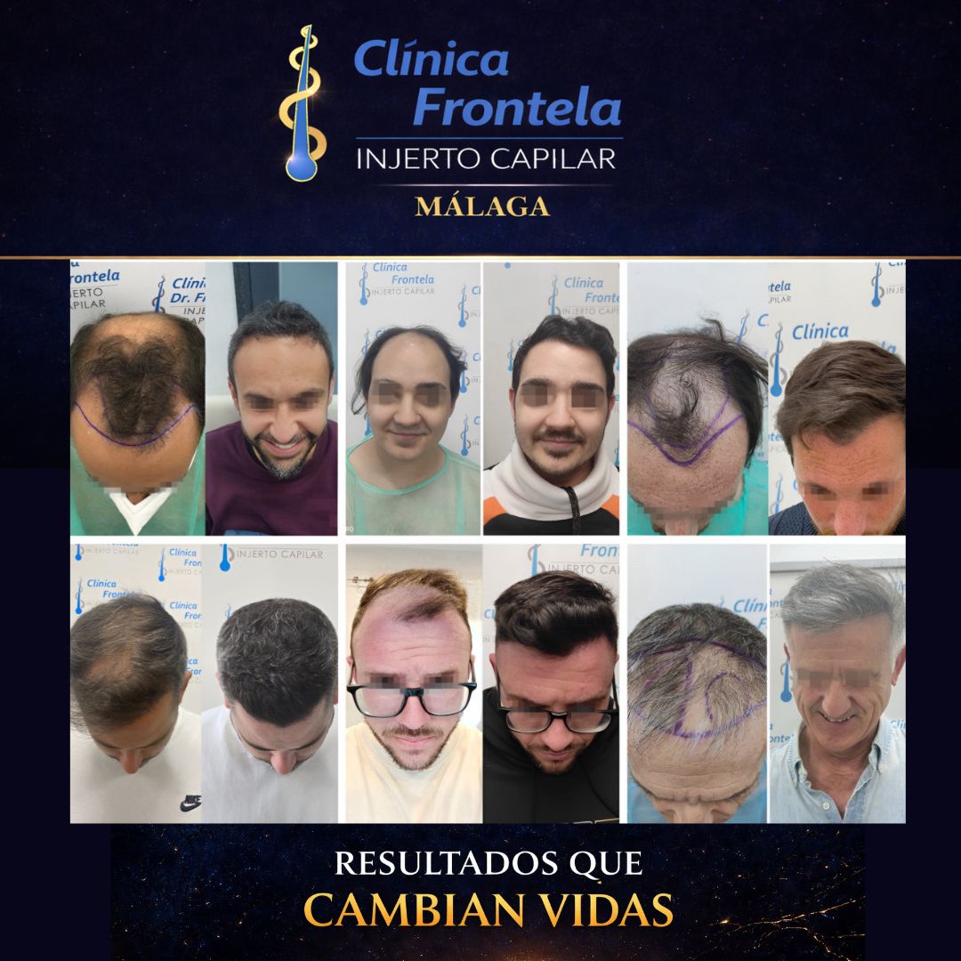 Clinica Injerto Capilar Frontela Facebook ad