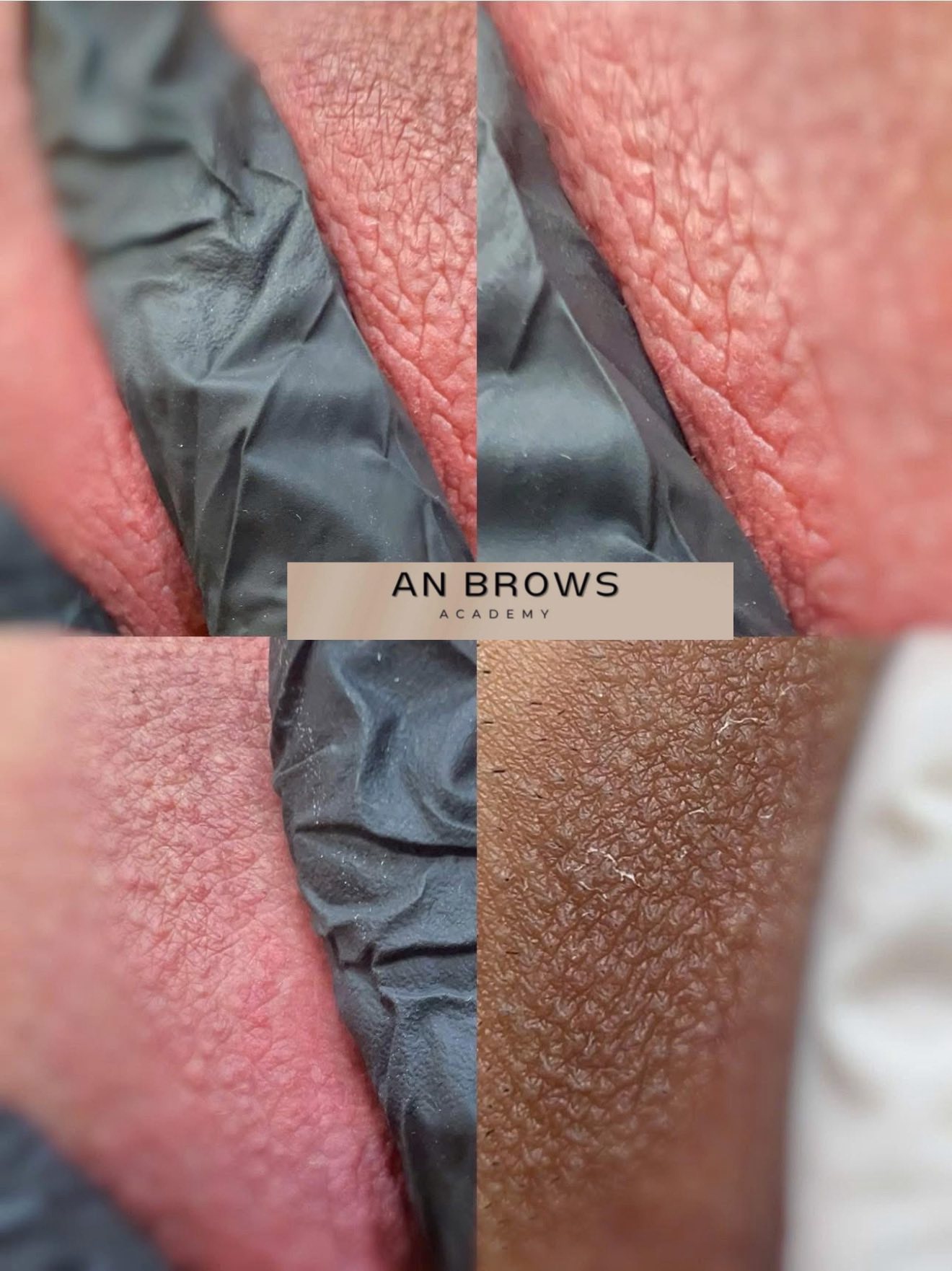 Bill Beauté Center Facebook ad: អស់បារម្មណ៍ បញ្ហារខ្មៅជាំ បន្ទាប់ពីសម្រាលកូនទៀតហេីយចា៎