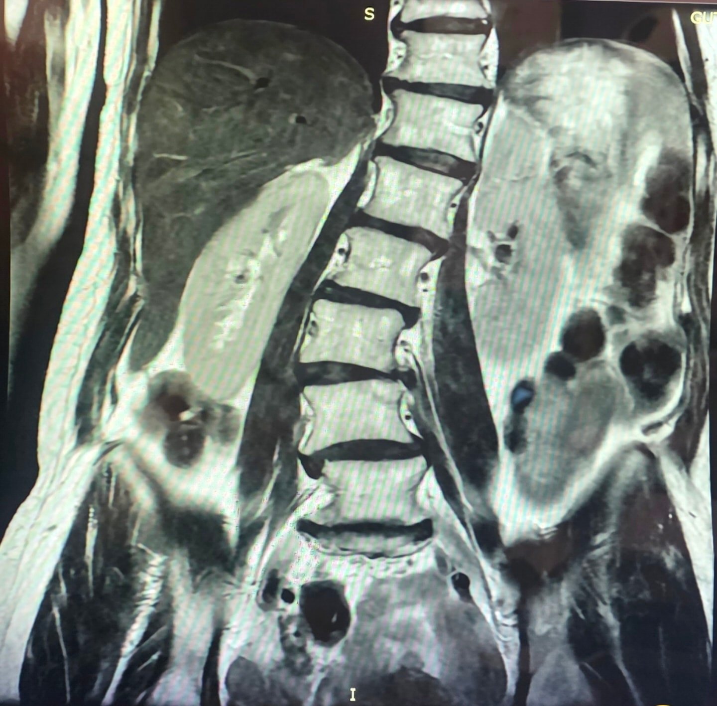 Neurocirugía de Cráneo y Columna Vertebral de Tijuana Facebook ad: IMPRESIONANTE ENDEREZAMIENTO DE COLUMNA VERTEBRAL.