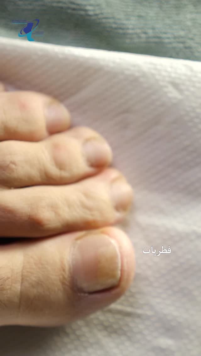 العيادة الحديثة لجراحة القدم والكاحل The Modern Podiatry Facebook ad: تُعد فطريات الأظافر من أكثر المشاكل شيوعاً، وقد…