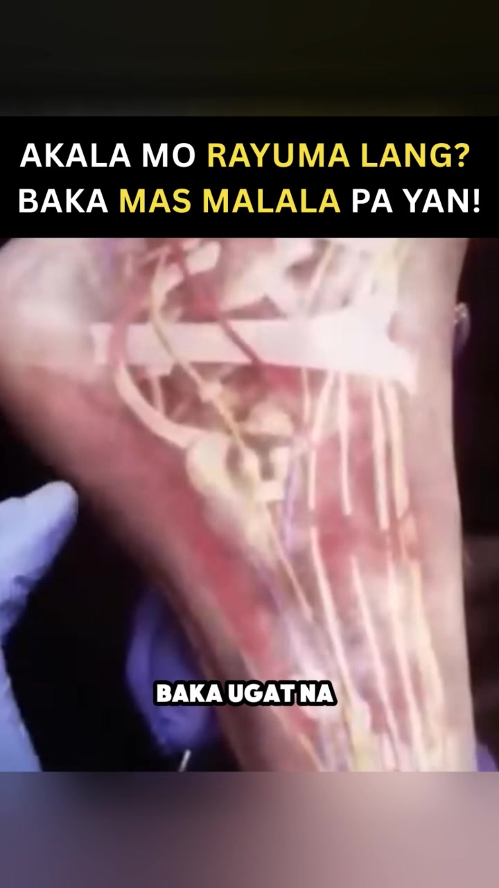 Dok Reyes - Neurolix Neuropathy Nerve Support Supplement Facebook ad: Pamamanhid at tusok-tusok?