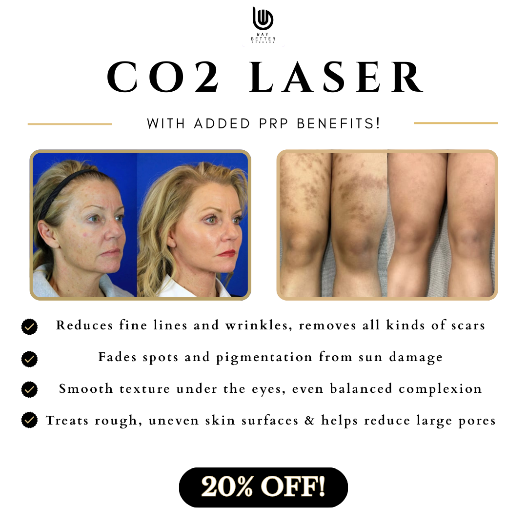 Way Better Laser Clinic Facebook ad: 20% OFF CO2 Laser Resurfacing + PRP