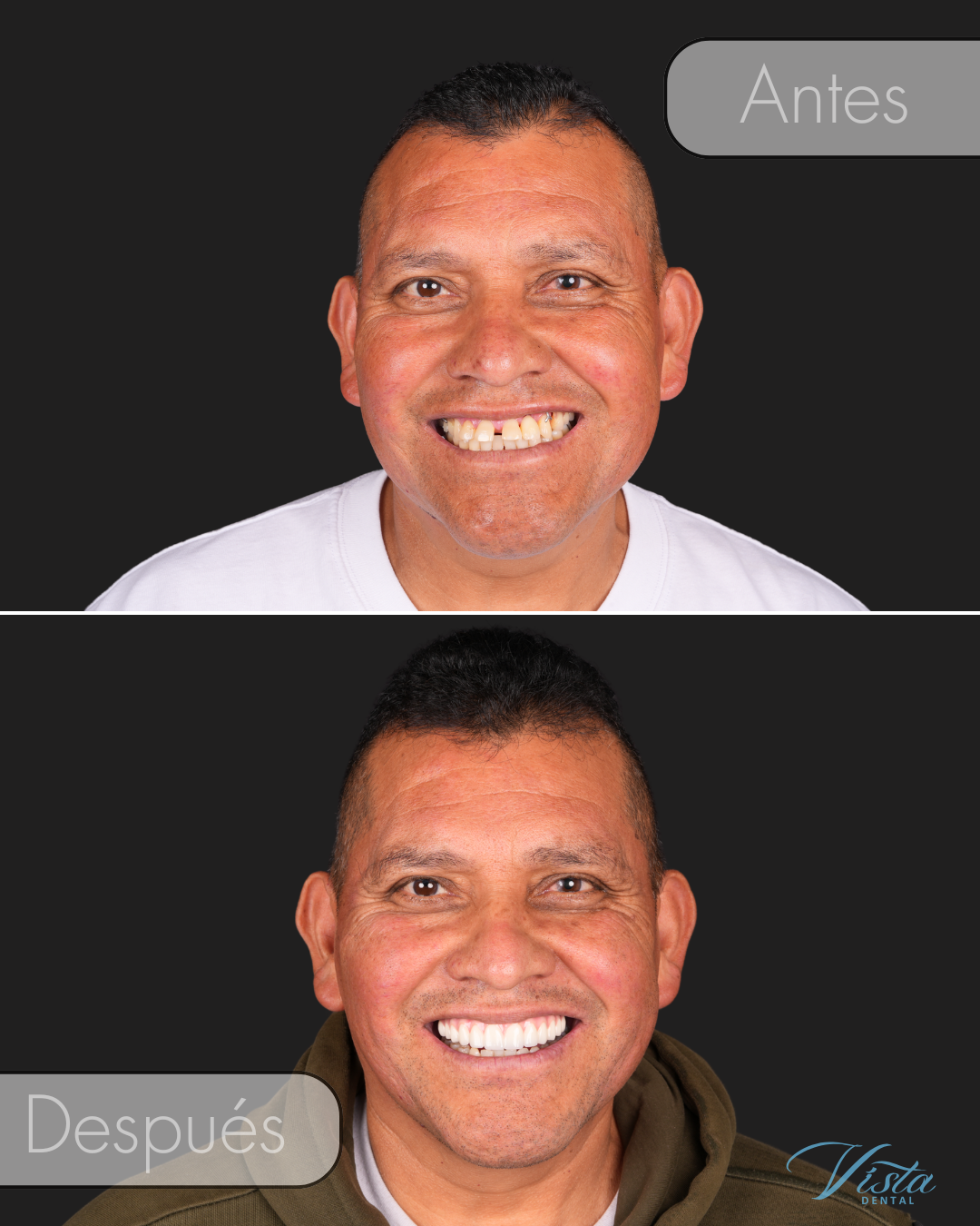Vista Dental Implants in Vancouver, WA Facebook ad: Descubre si calificas