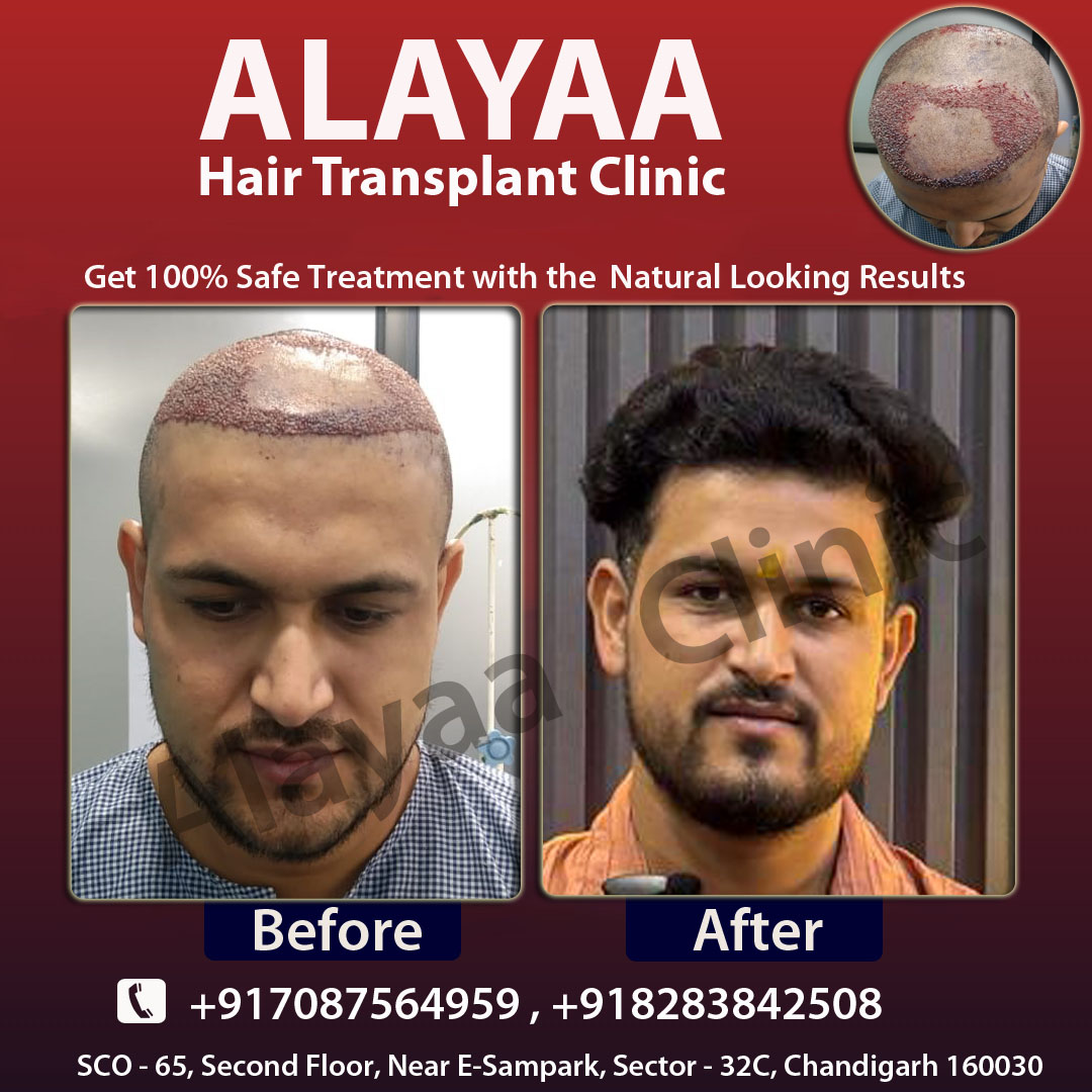 Alayaa Clinic - Hair Transplant Specialist Facebook ad: Alayaa Clinic Is one of the best and…