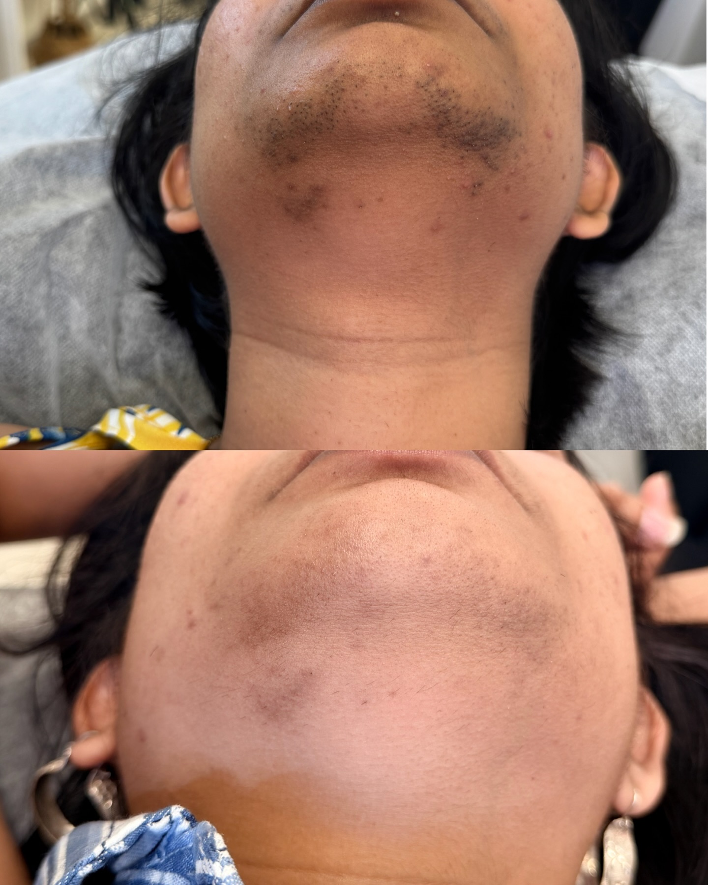 The Brow Bar 868 Facebook ad: Laser Hair Removal