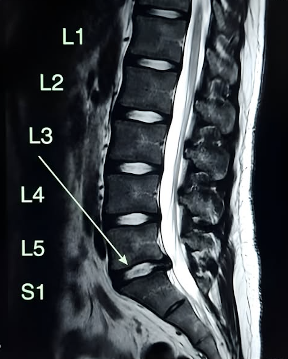 Dr. med. Peter Koch Facebook ad: Was dir Chiropraktiker NICHT erzählen!
