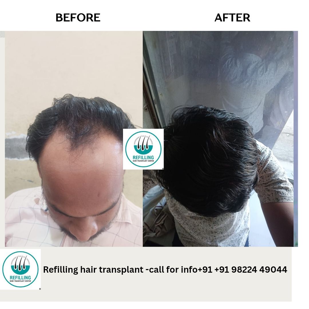 Refilling Hair Transplant Center India Facebook ad: Trusted By 10 Lakhs+ Indians