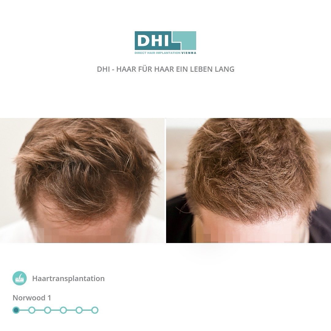 DHI Vienna - Haartransplantation und Behandlungen von Haarausfall Facebook ad: Premium Haartransplantation in Wien