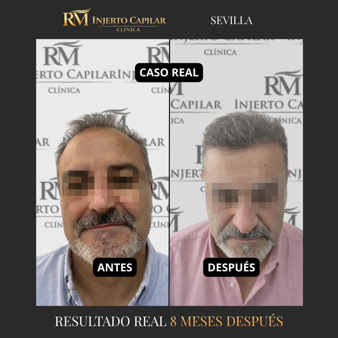RM Injerto Capilar Facebook ad from Mar 16, 2026