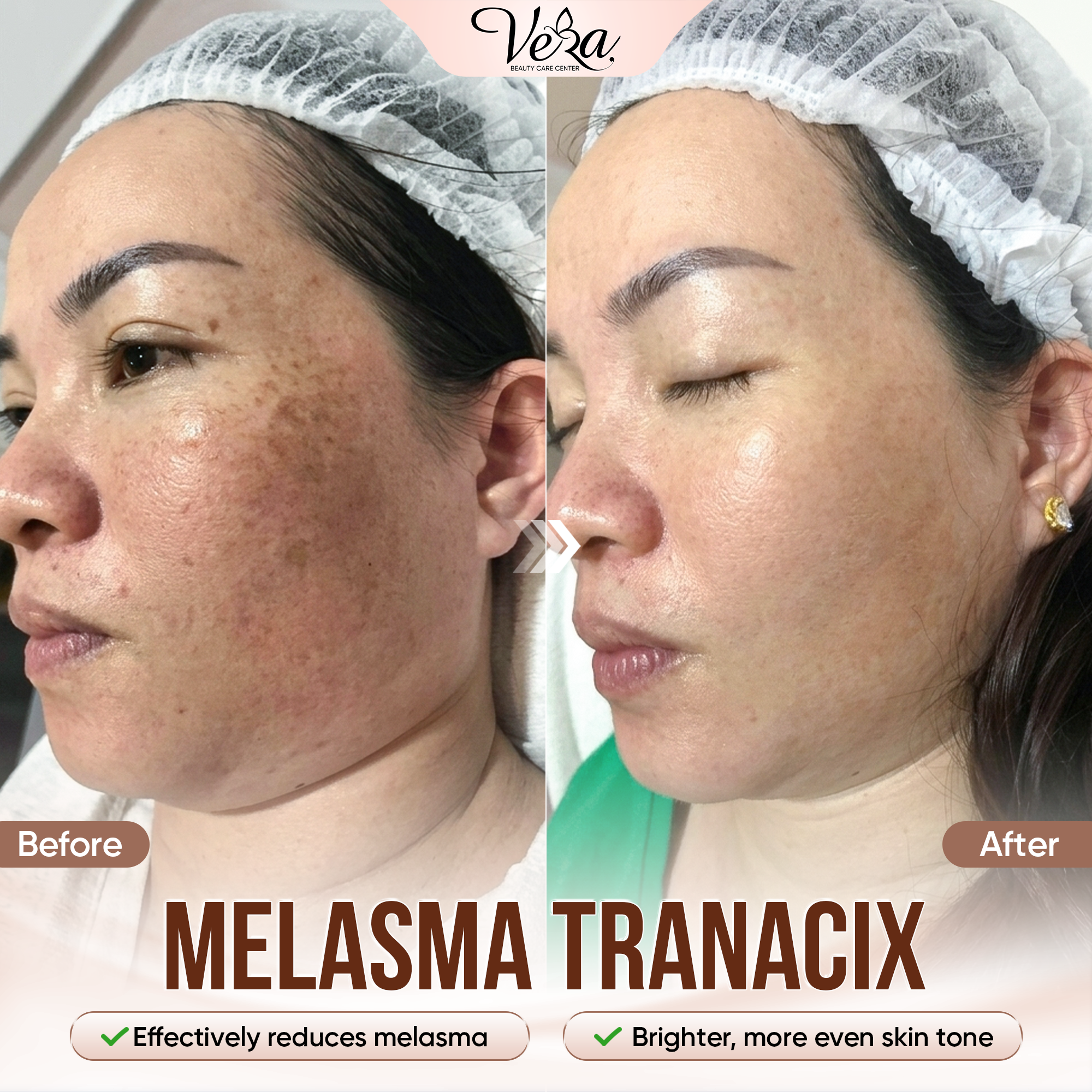 Vera Beauty Skincare Center Facebook ad: Effective up to 90%