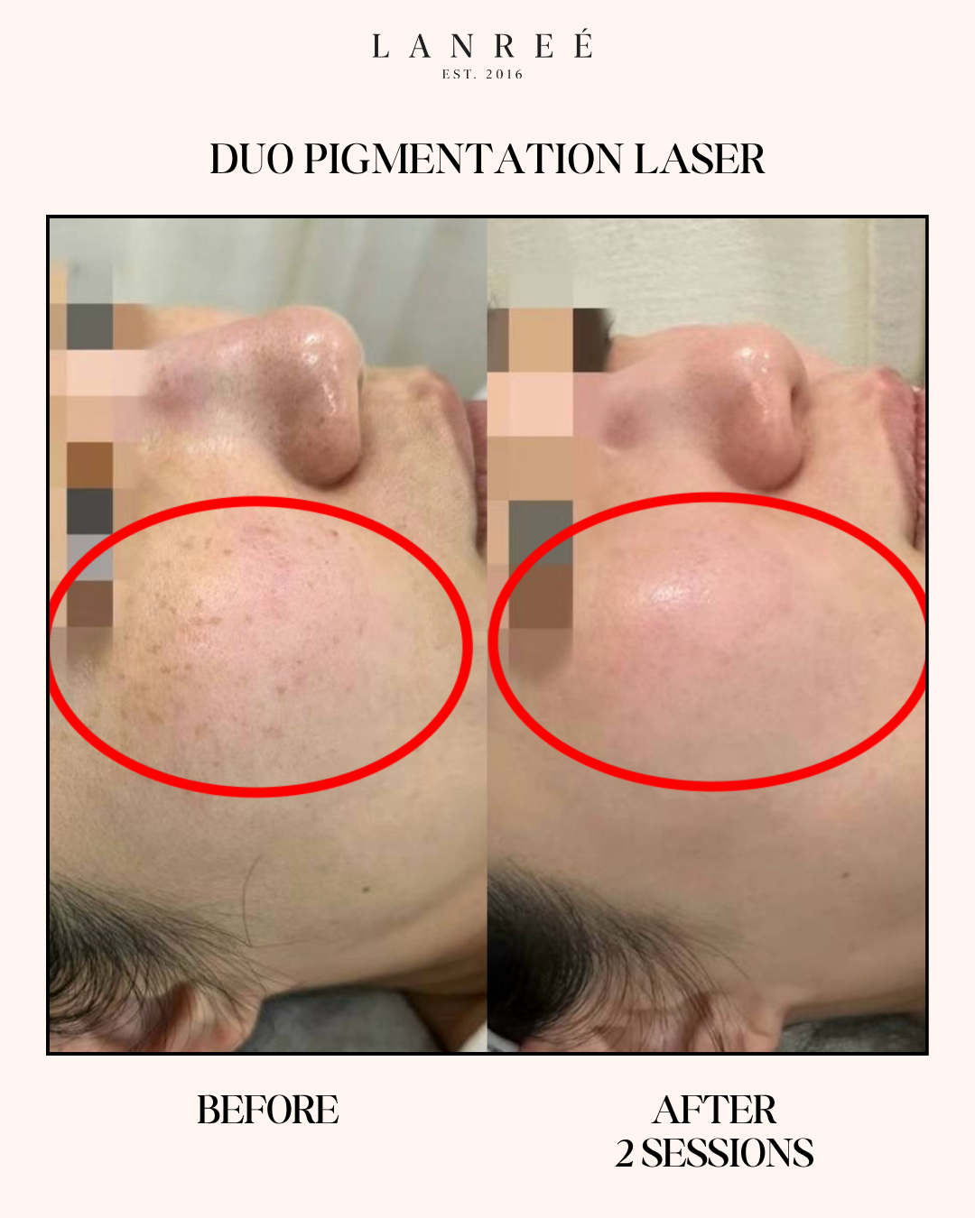 Lanree Aesthetics Facebook ad: Instagram