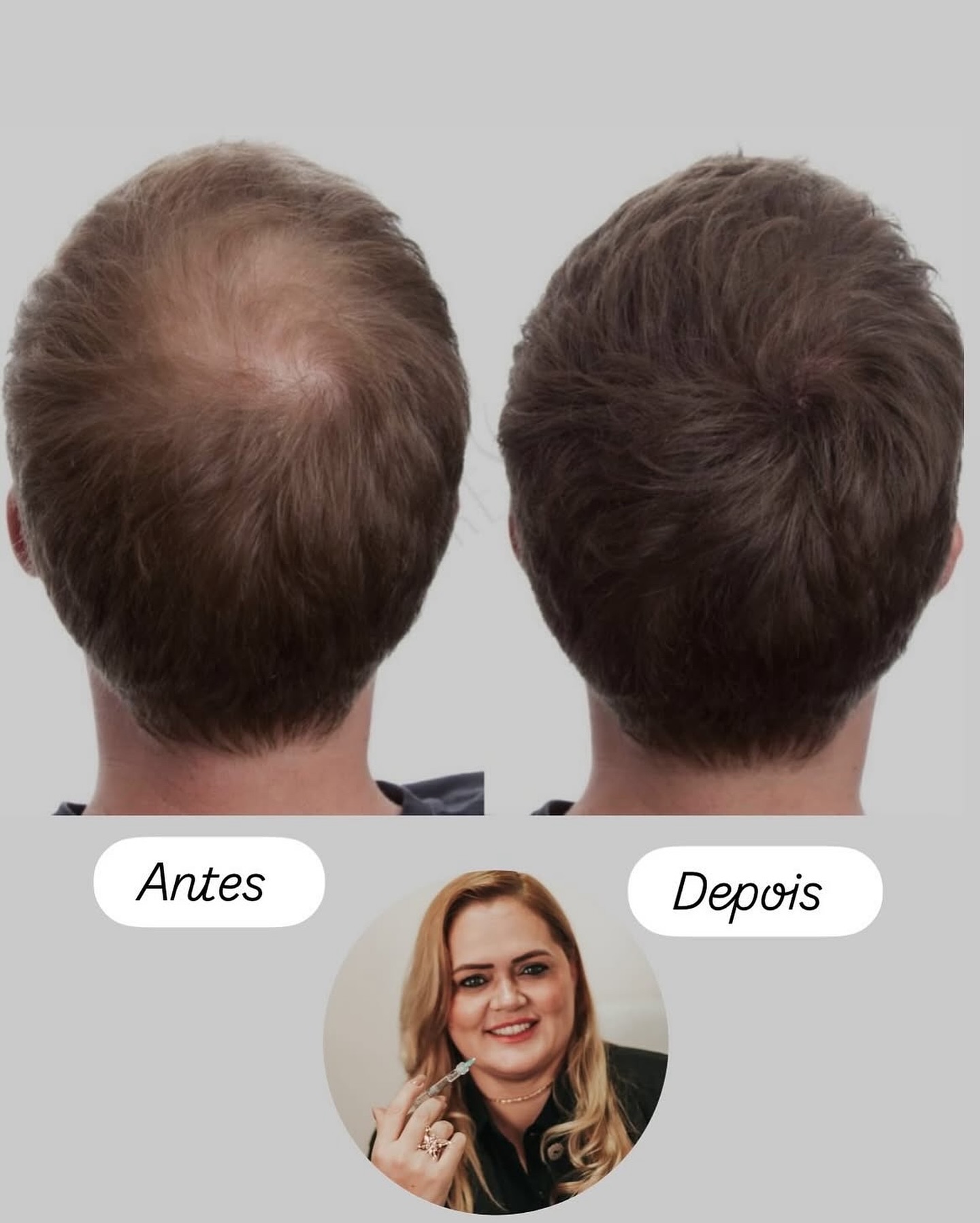 clinicadalilaamaral Facebook ad: Mesoterapia Capilar
