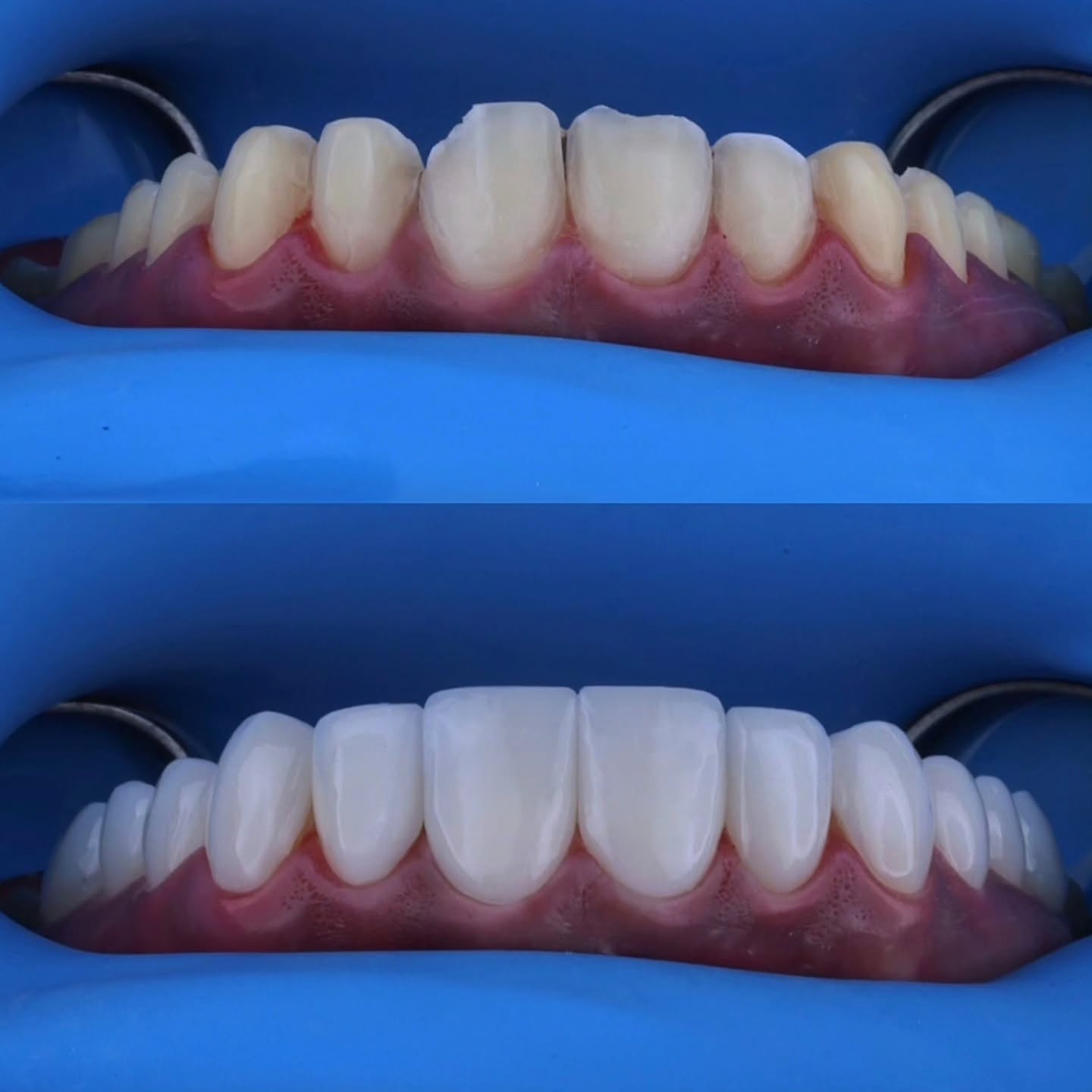 Martin Prato Luxury Smile Facebook ad: Best smiles design porcelain veneers, las mejores sonrisas…