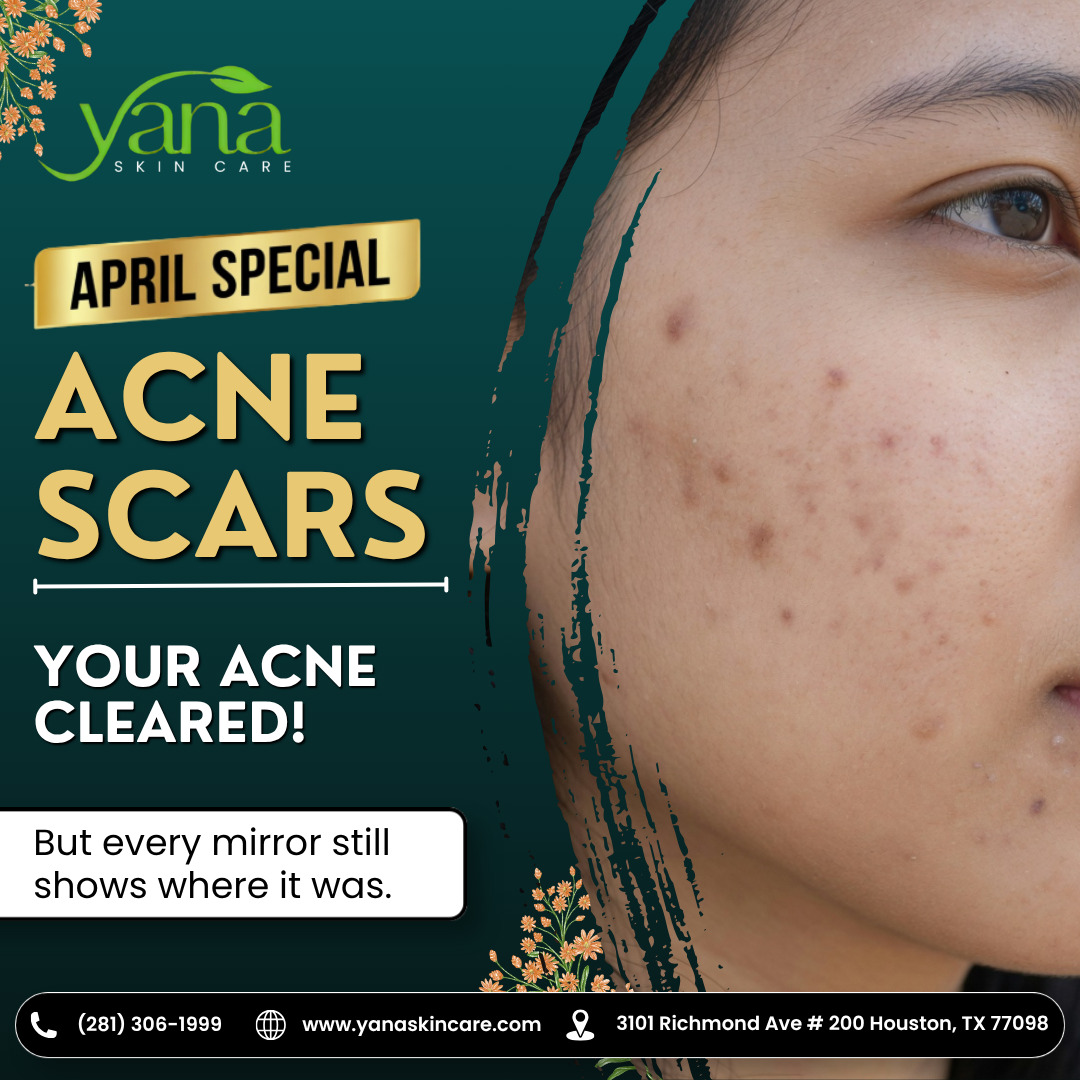 Yana Skin Care Facebook ad: $169 for Laser Genesis, Get Rid of Acne…