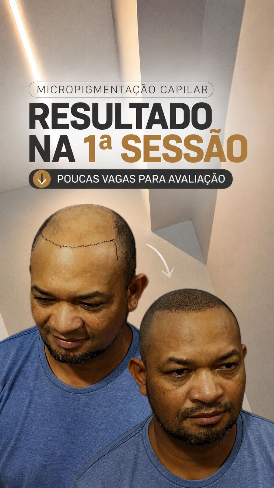 Breno Kaiê - Micropigmentação capilar Facebook ad: Agende Sua Avaliação