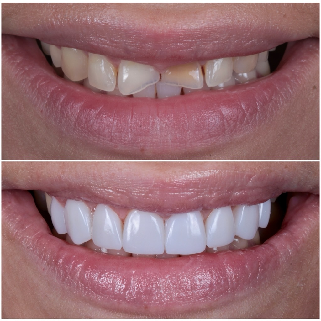 drjamesdentith Facebook ad: Invisalign + Composite Veneers =