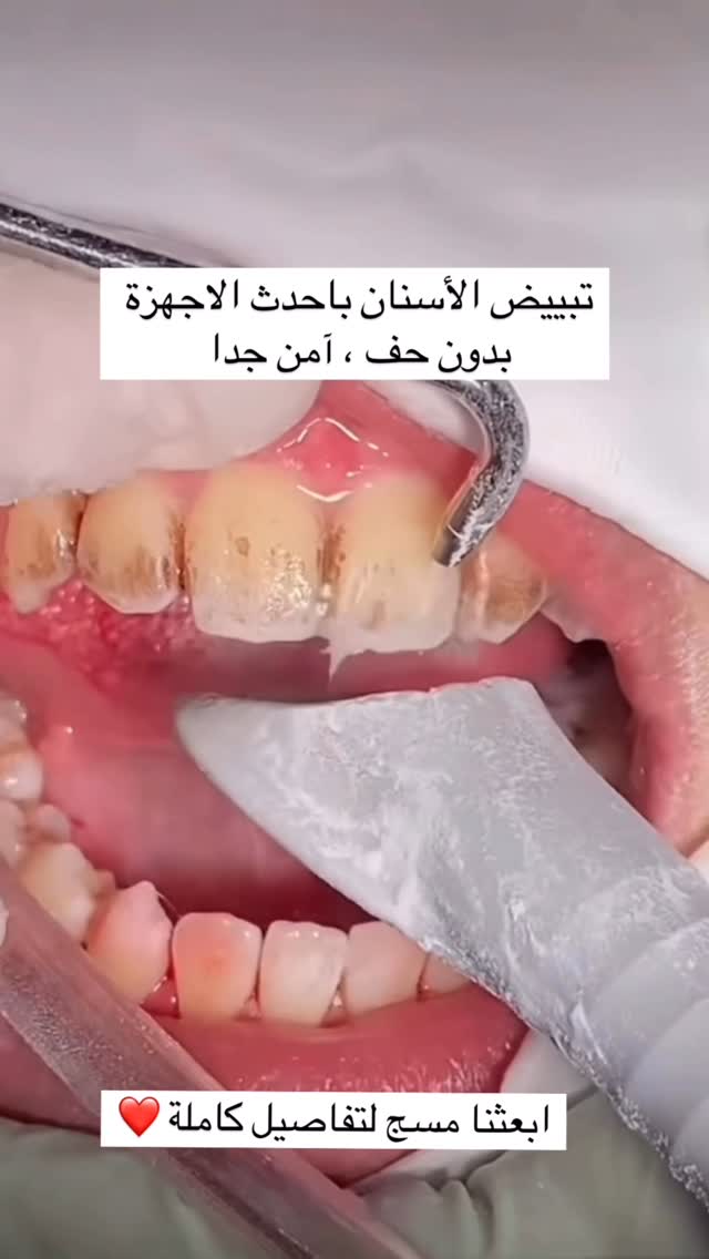 Dentalstationjo Facebook ad: تبييض الأسنان الفوري office teeth whitening
