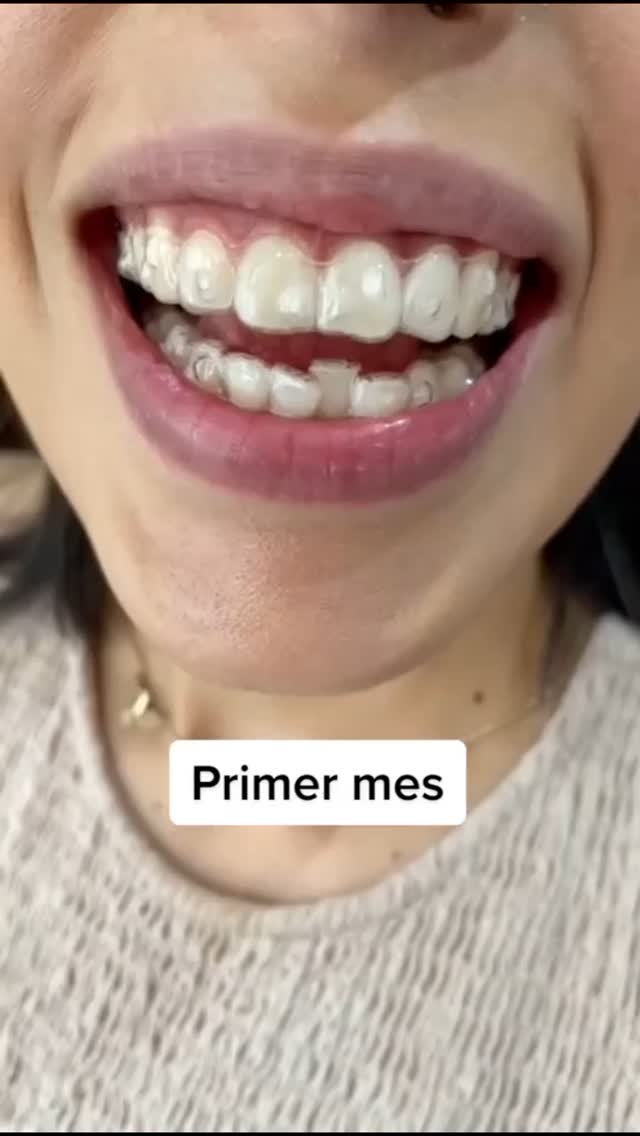 Bayres Dental Oeste Facebook ad: Porqué elegir alineadores invisibles?