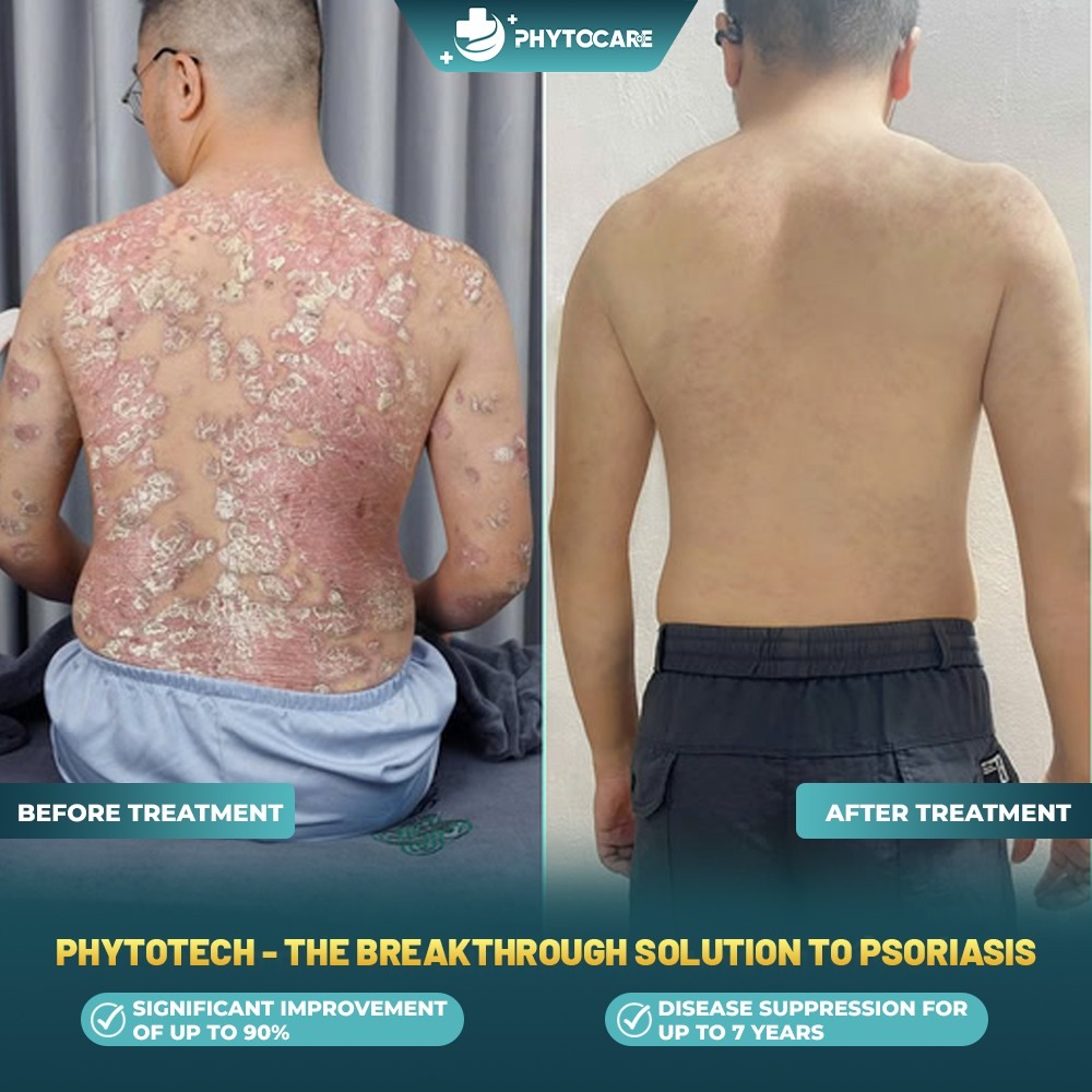 Phytocare Clinic Makati Facebook ad: PSORIASIS IS NOT JUST A SKIN PROBLEM!