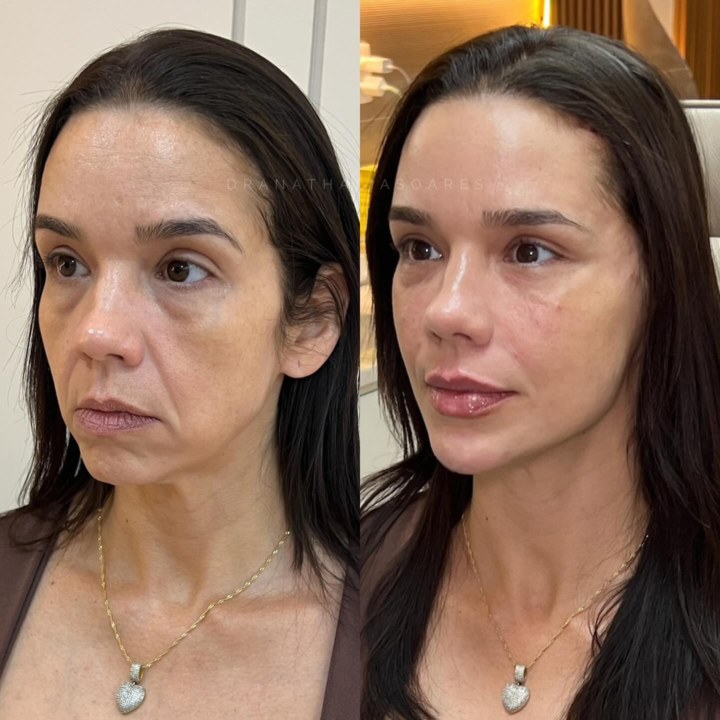 Dra Nathália Soares HOF Facebook ad: ELA PASSOU POR EMAGRECIMENTO E SENTIA O SEU…
