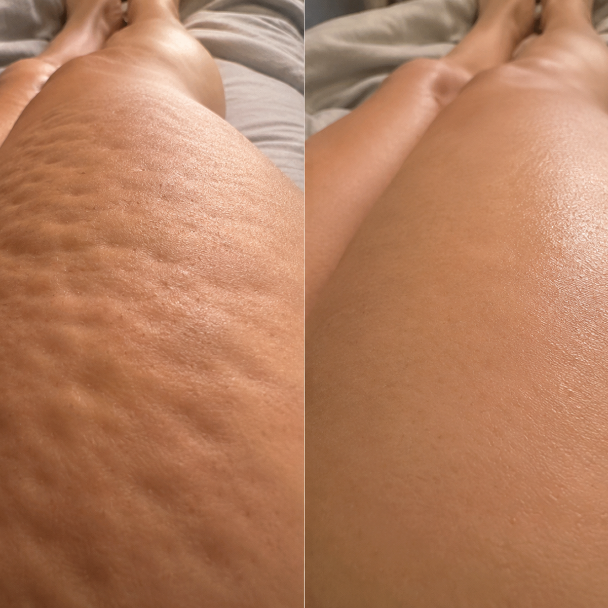 Emily Thompson Facebook ad: The Top 5 Cellulite Brands That Actually Release Trapped…