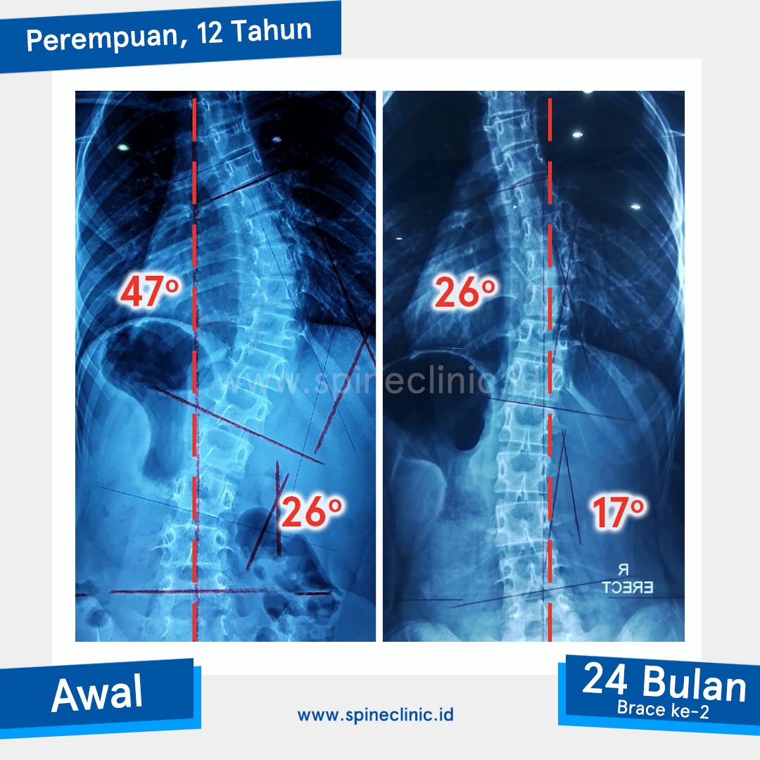 Spine Clinic Facebook ad: Kapan sebaiknya skoliosis ditangani?