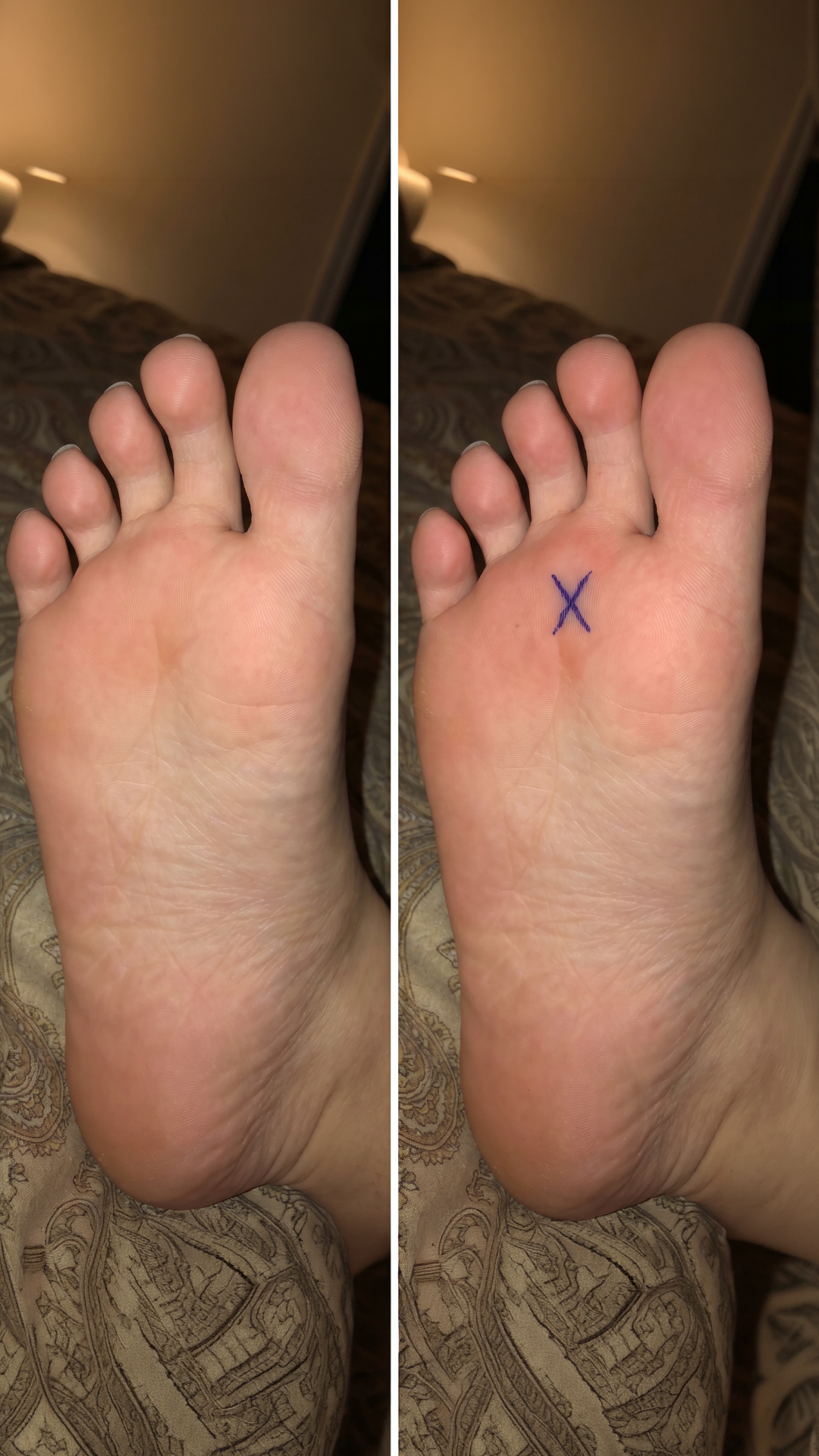Robert Halverson Facebook ad: The Morton's neuroma mistake most podiatrists never check