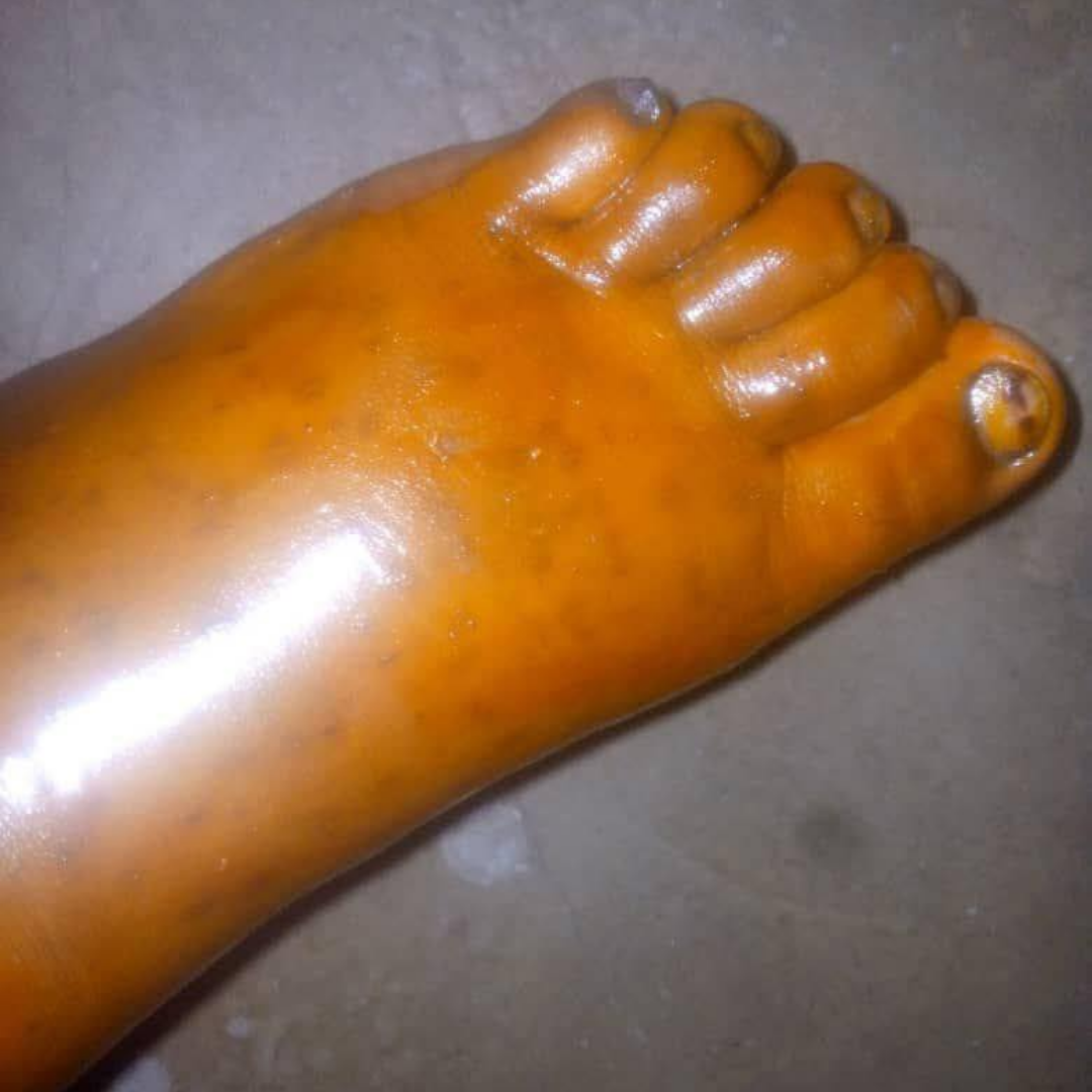 Megan Carter Facebook ad: I read this article about leg swelling…