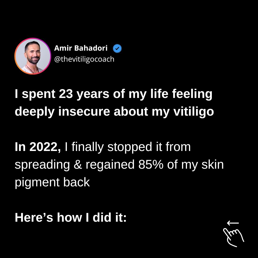 The Vitiligo Coach Facebook ad: Living with vitiligo for most of my life…
