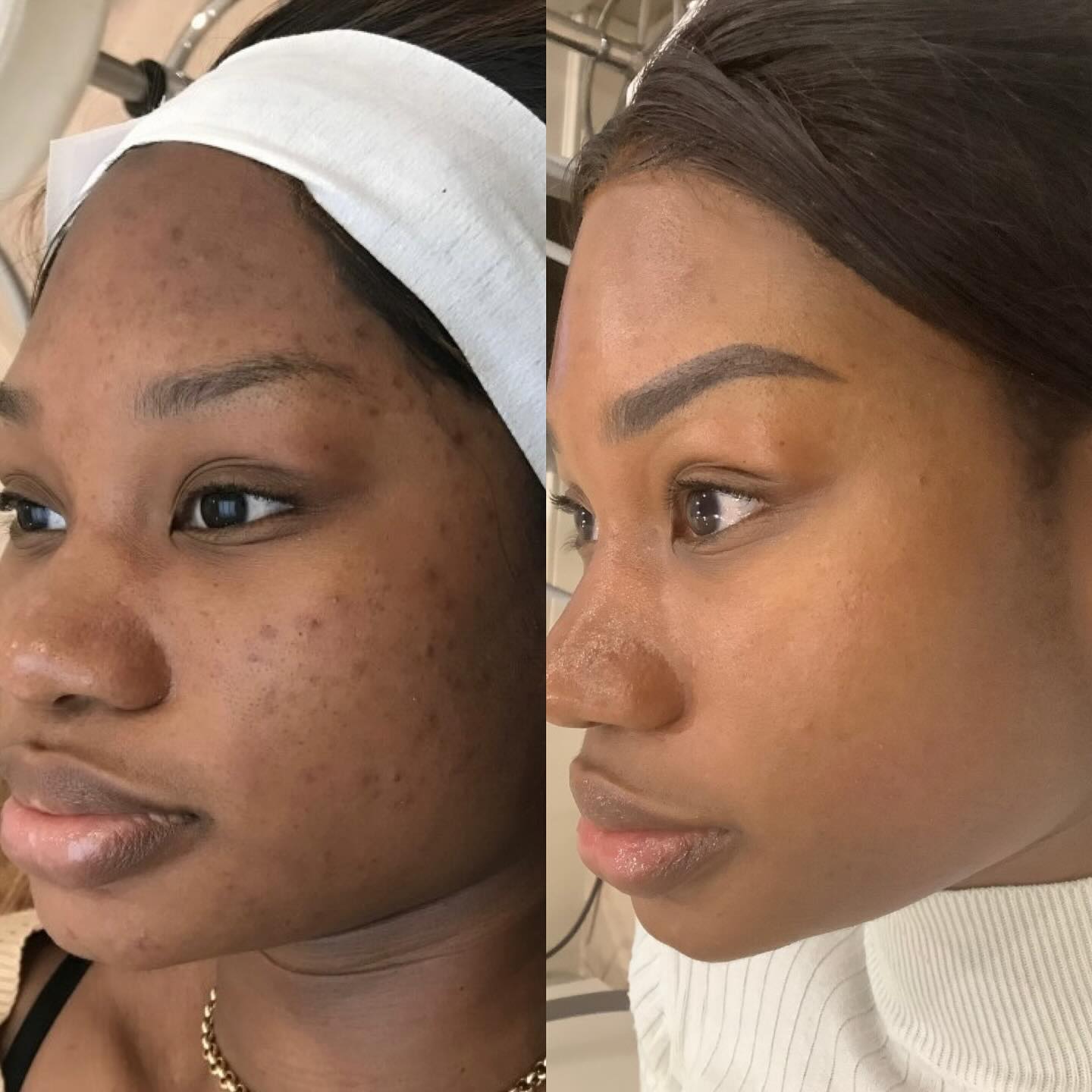 Pulse Laser Aesthetic Clinic - London Facebook ad: @jacqueline.ilu shares her honest review on the improvement…