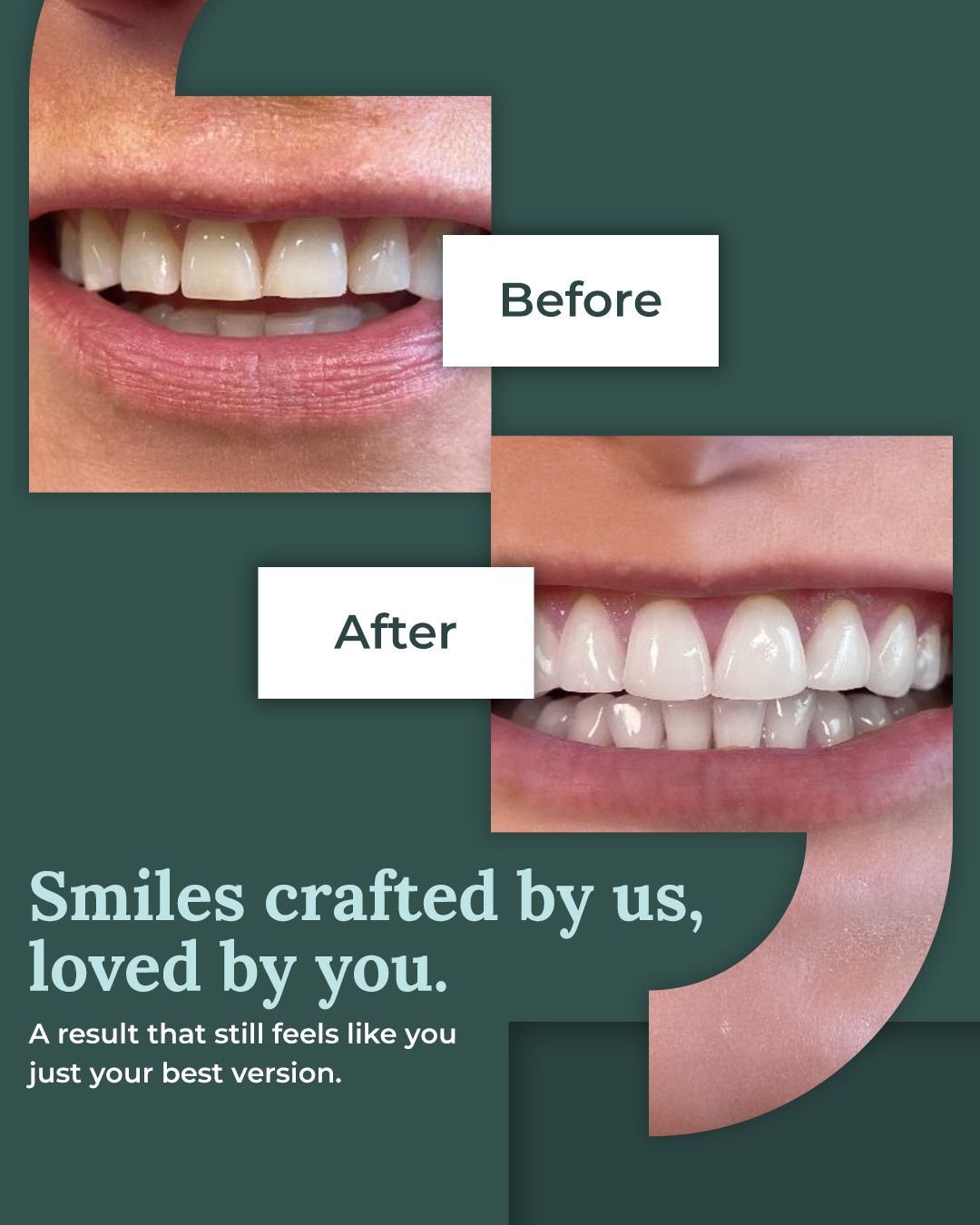 Shields Dental & Orthodontic Clinic, Dublin, Limerick & Tipperary Facebook ad: Teeth Straightening | Limerick