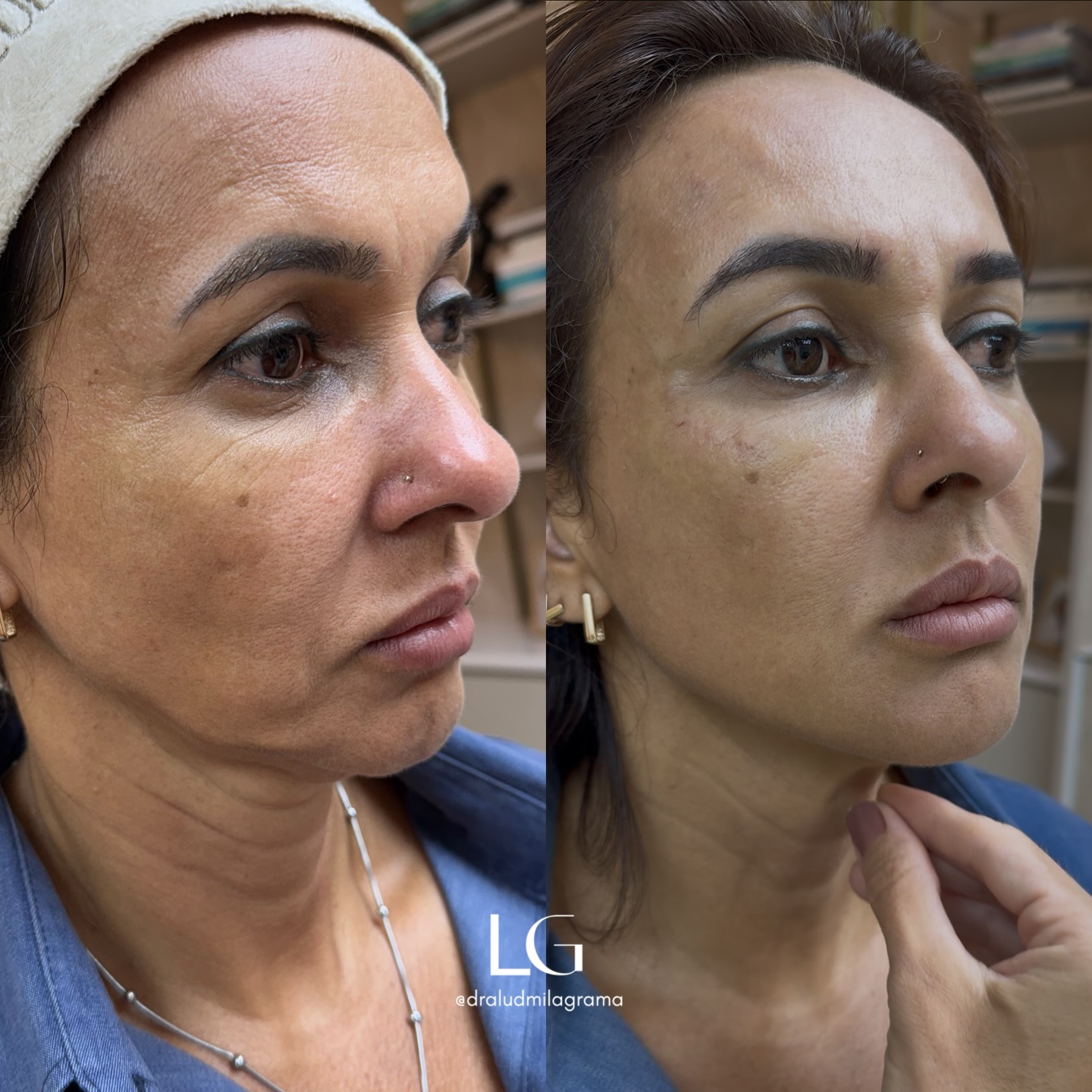 Dra Ludmila Grama - Harmonização Facial Facebook ad: Flacidez não aparece só com a idade.
