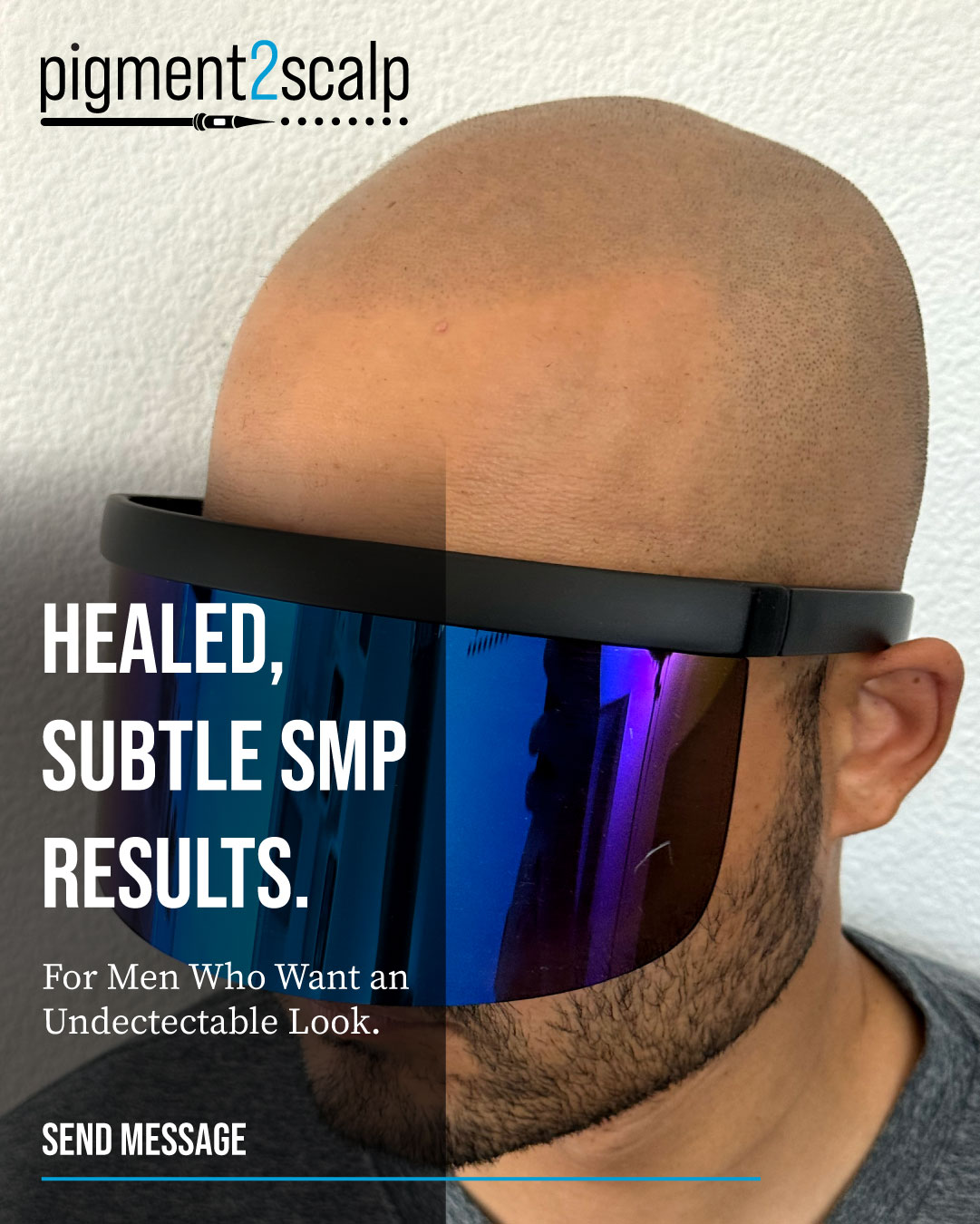 Pigment2scalp Micropigmentation Facebook ad: Subtle. Natural. Undetectable.