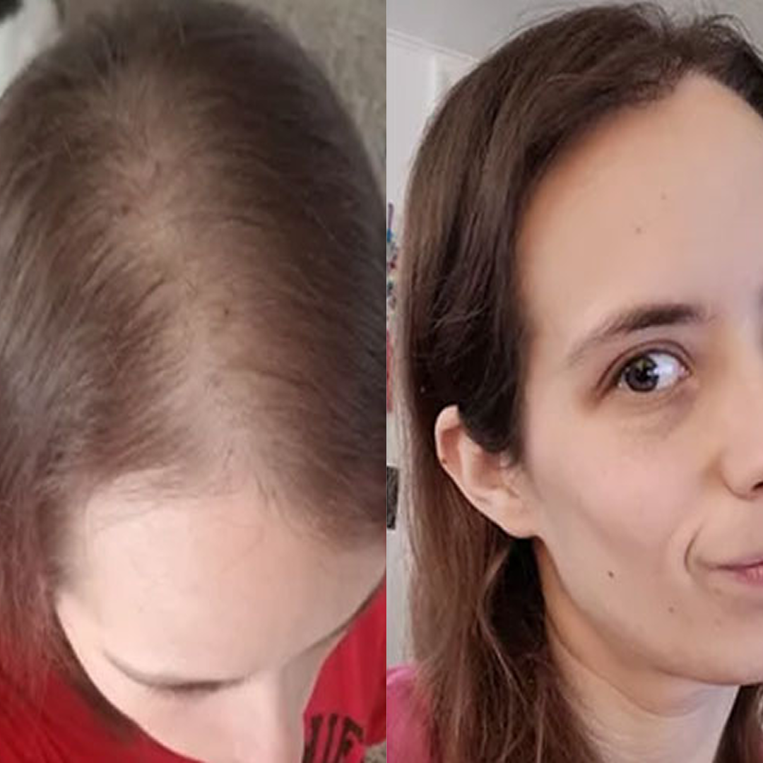 Jennifer Nelson Facebook ad: Reverse GLP-1 Hair Loss