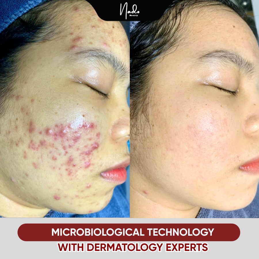 Nado Clinic & Spa - Davao Facebook ad: Severe inflammatory acne, the longer you wait, the…