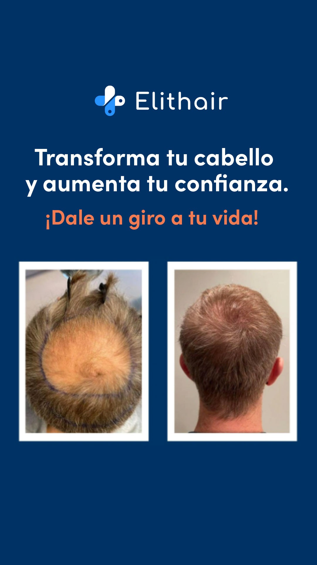 Trasplante Capilar Turquía - Elithair Facebook ad