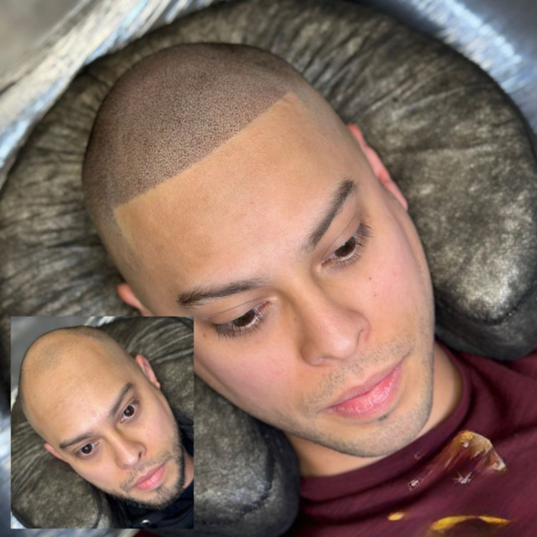 Elegantmicro Facebook ad: Guaranteed hair loss solution without surgery