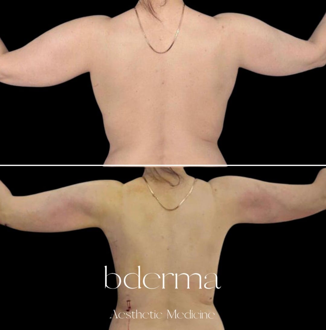 Clínica bderma Facebook ad: Endolift