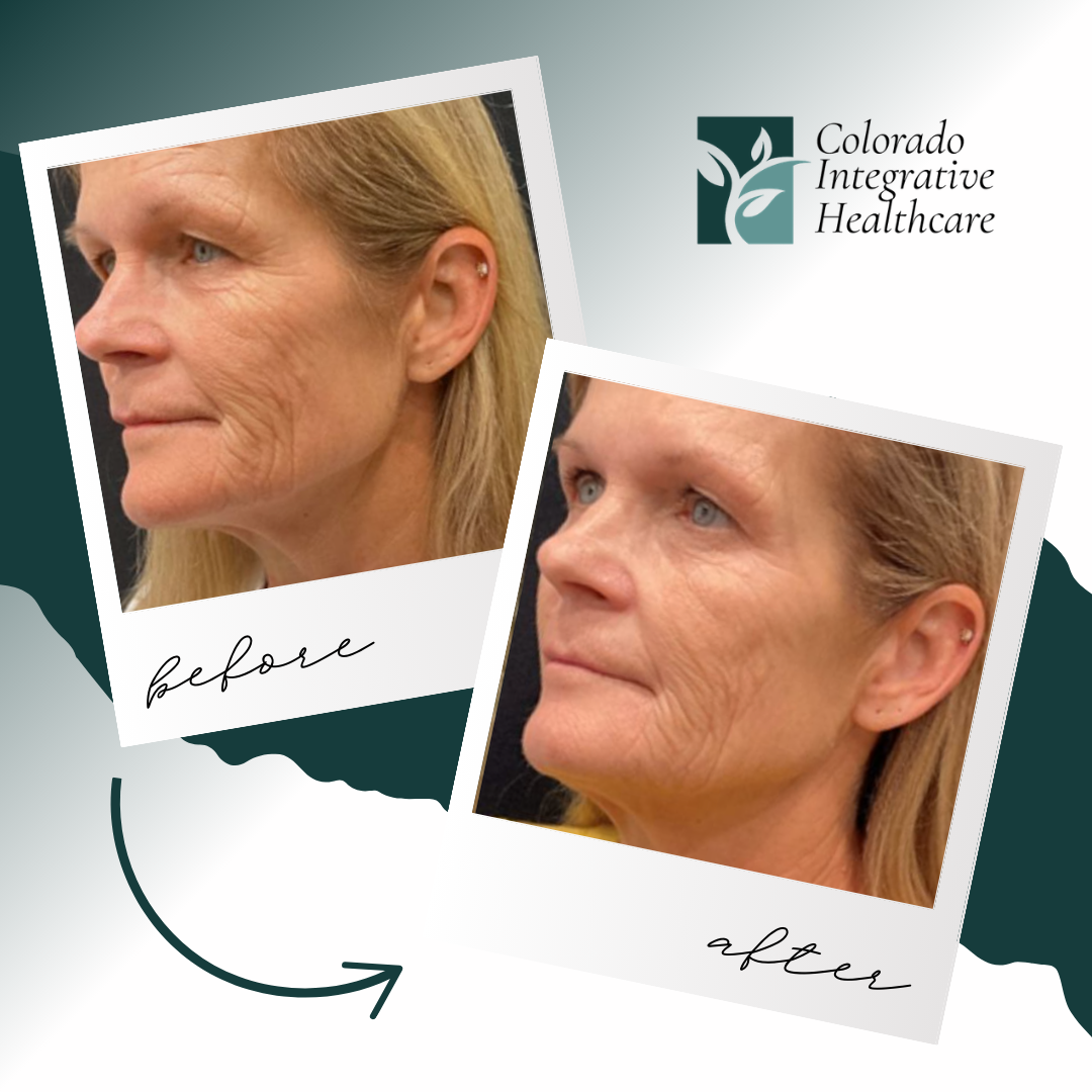 Colorado Integrative Healthcare Facebook ad: 30% OFF Sofwave Skin Tightening LIMITED TIME OFFER