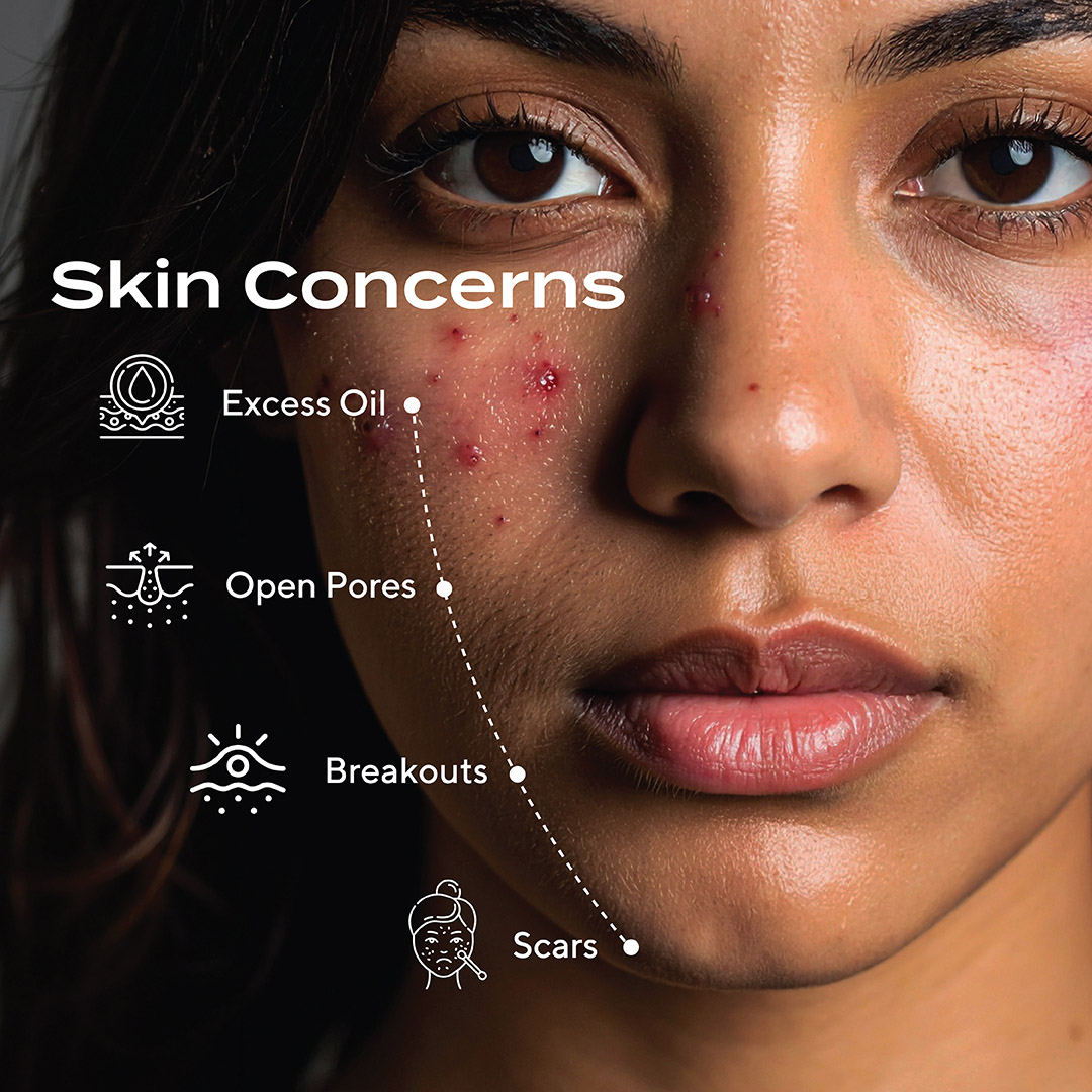 Murad Facebook ad: POV: You’ve tried everything… but the breakouts keep…