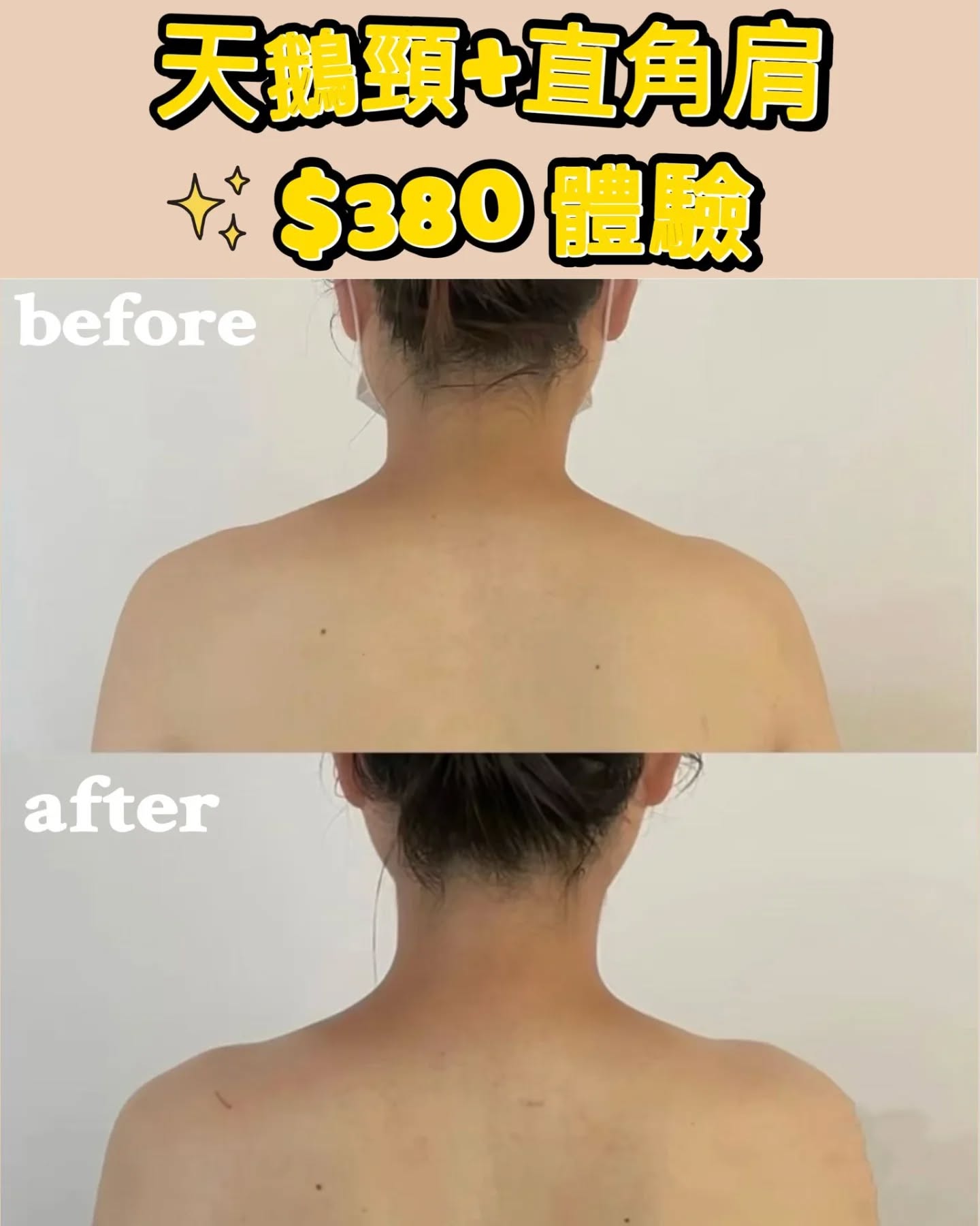 ocean.beauty_care Facebook ad: 無論你是圓肩/聳肩,駝背,還是高低肩……