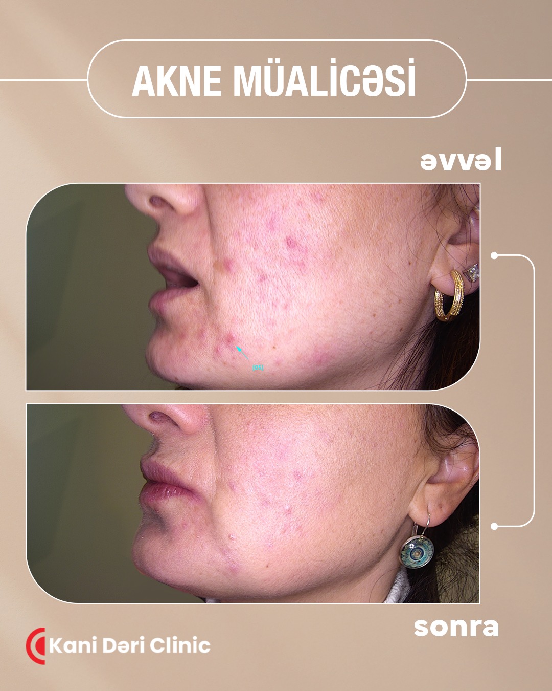 Kani Dəri Clinic Facebook ad: Bəzən akne bitmək bilmir, nə qədər baxım məhsulu…