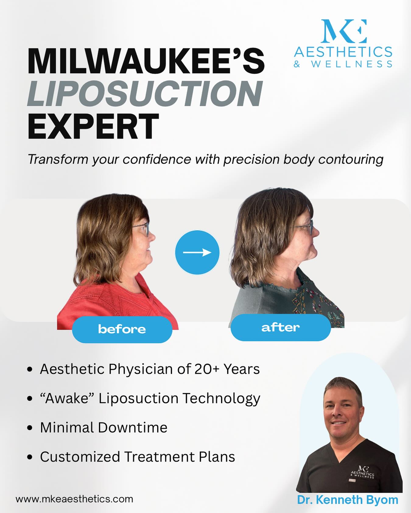 MKE Aesthetics & Wellness Facebook ad: Awake Chin & Neck Contouring in Milwaukee